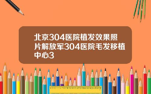 北京304医院植发效果照片解放军304医院毛发移植中心3